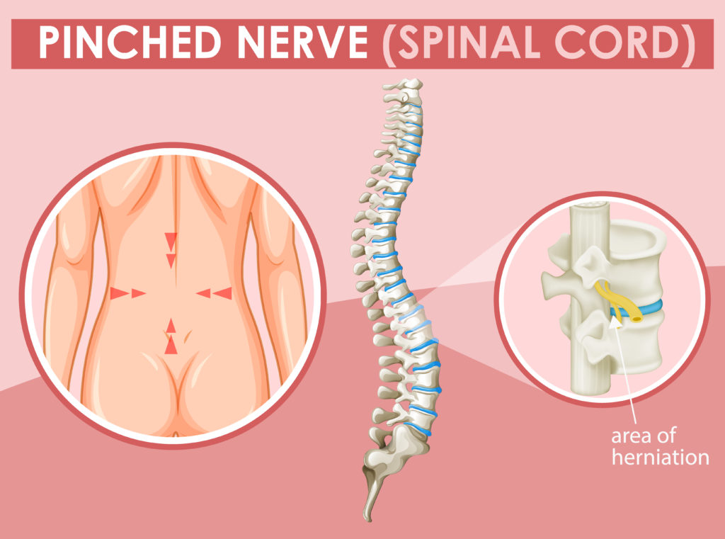Pinched Shoulder Blade Nerve: Symptoms and Pain Relief