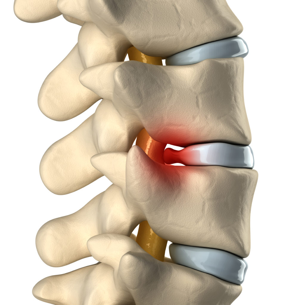 Disc Herniation Chiropractic Solution